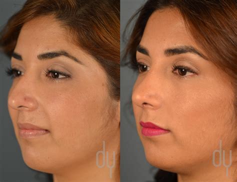Nose Job Before And After Plastic Surgery Khaleej Mag Vrogue Co