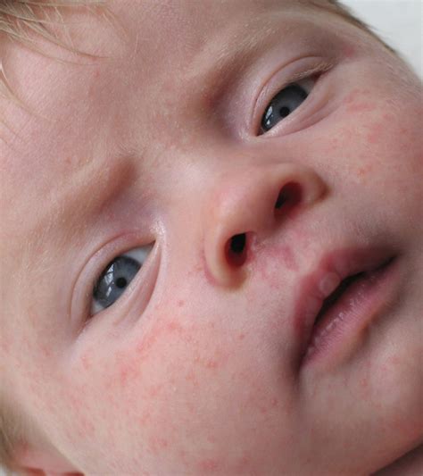 5 Types Of Skin Allergies In Babies Treatment And Prevention