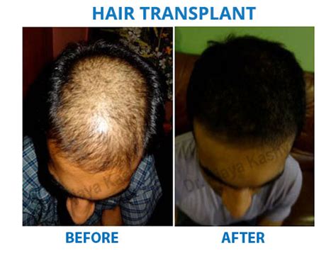 Hair transplant costs can vary depending on the degree of hair loss and desired look. Hair Transplant Surgery in Delhi is low Hair Surgery Cost ...