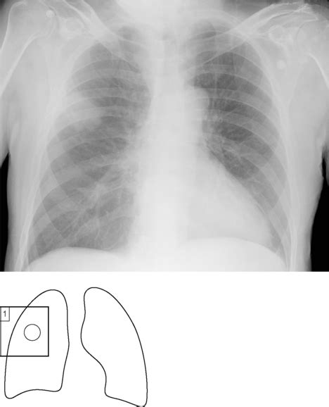 Lung Cancer And The Solitary Pulmonary Nodule Radiology Key