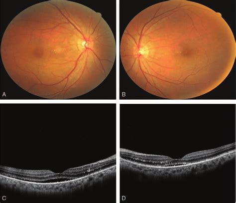 Fundus Photography And Optical Coherence Tomography Oct Of Both Eyes