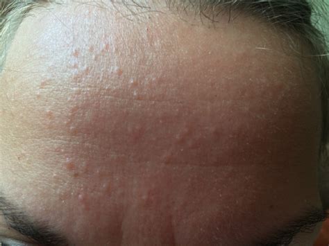 Small Flesh Colored Bumps On Forehead And Hairline Adult Acne By