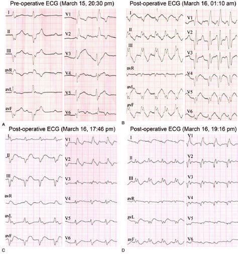 Postoperative Echocardiography Ecg Showed Regressed Left Anterior
