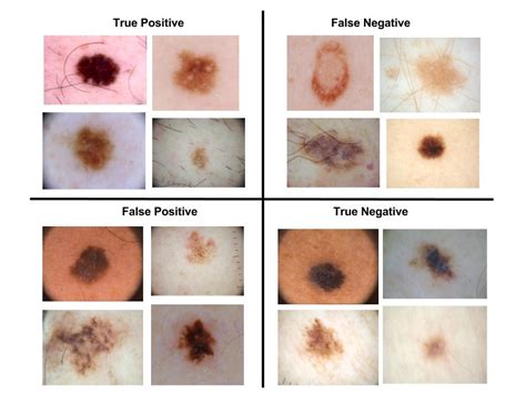 A Simple Way To Spot Melanoma Remember The Abcdes Mel