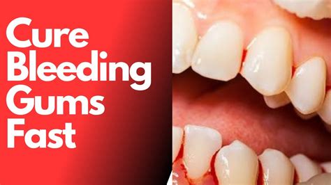 How To Stop Bleeding Gums Fast Without Going For Dental Treatment