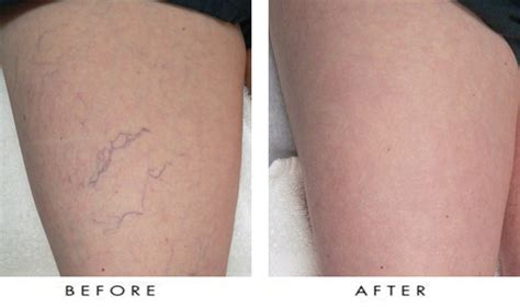 Spider Veins On Legs Before After Vancouver Laser Skin Care Clinic