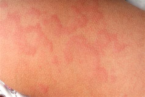 Urticaria Causes And Treatment Of “hives” Qoctor Your Quick Online Doctor