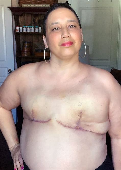 Breast Cancer Sufferer Poses Topless To Show Off Her Double Mastectomy