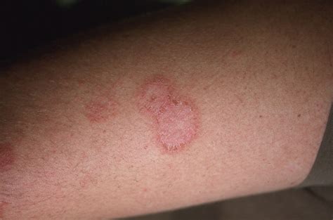 What Does The Early Stages Of Ringworm Look Like