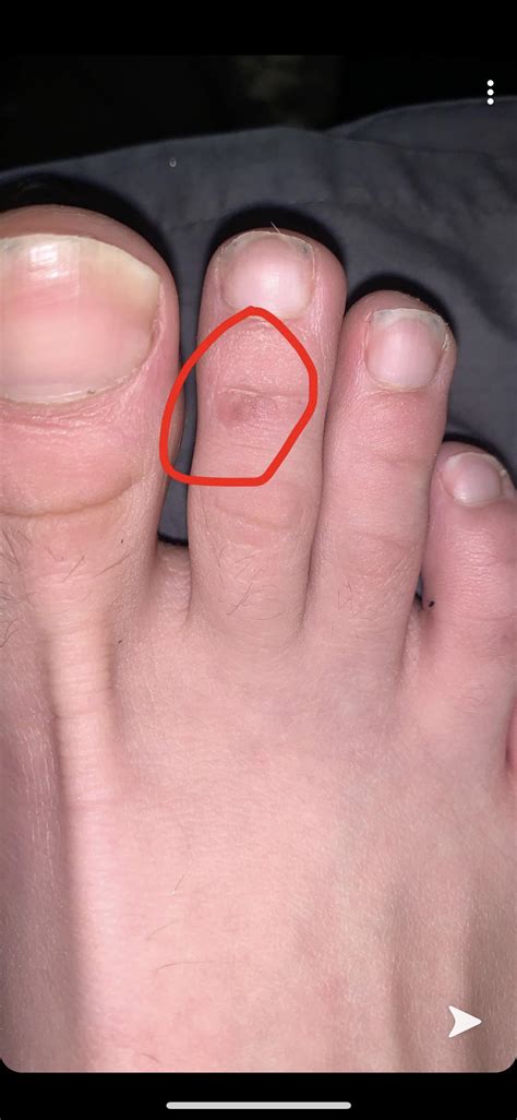 Hi Does Anyone Know What This Spot On My Toe Could Be Skincareaddicts