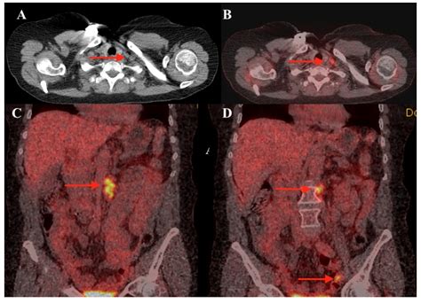 Diagnostics Free Full Text Left Supraclavicular Lymph Node