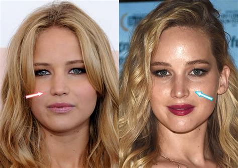 Jennifer Lawrence Plastic Surgery Before And After Ce