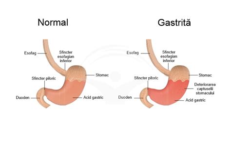 Gastrita Cronica Simptome Diagnostic Tratament My Xxx Hot Girl