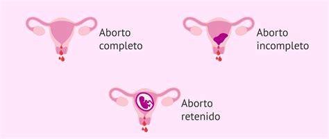 Tipos De Abortos Espontáneos Según La Variedad Clínica