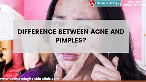 Difference Between Acne And Pimple Dermatologist Skin Clinic
