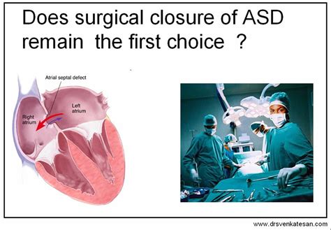 Management Of Atrial Septal Defect Device Closure Lagging Behind