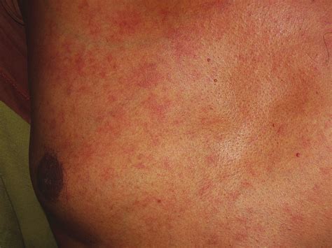 Diffuse Erythematous Macules And Telangiectasia Download Scientific