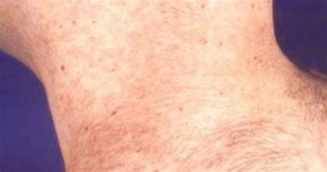 Drugs or medication causing rash. HIV Rash - Pictures (Images), Symptoms, on armpit, legs, face, hands, arms