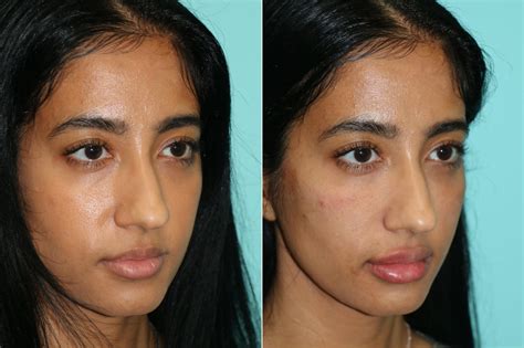 Cheeks Midface Injections Photos Chevy Chase Md Patient