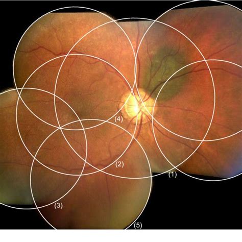 1 Examples Of Fundus Images In The Hei Med Dataset A African
