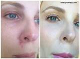Pimple Cover Up Makeup Images