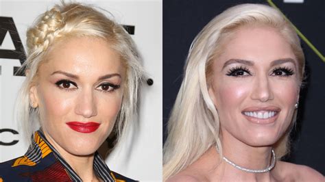 Gwen Stefani Had Multiple Plastic Surgery Procedures Experts Believe
