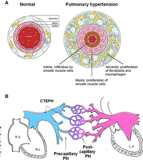 Sickle Cell Disease And Pulmonary Hypertension Captio Vrogue Co