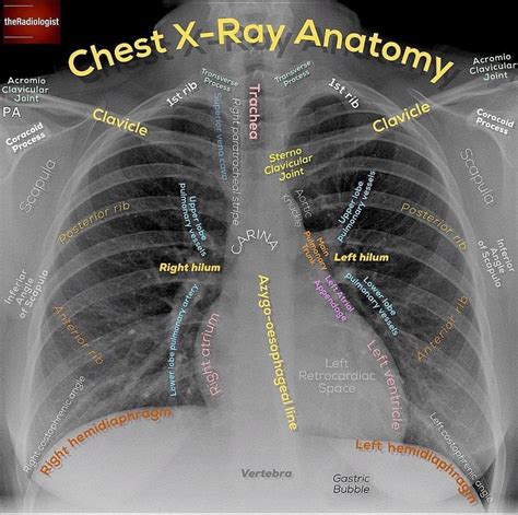 Chest Xr Radiology Medical Anatomy Radiology Student