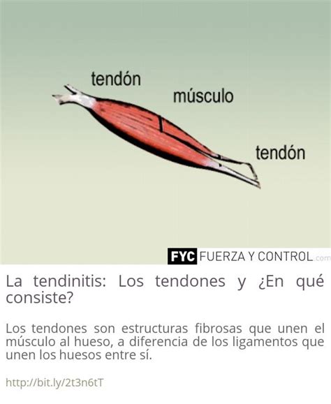 La Tendinitis Los Tendones Y ¿en Qué Consiste Tendinitis Musculos