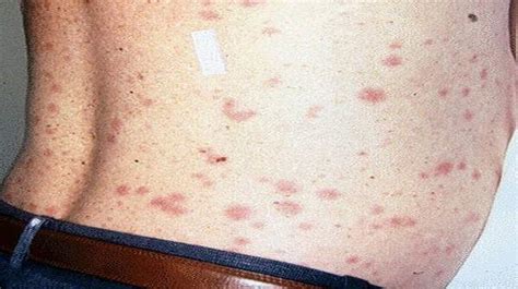 Typhus Symptoms Signs And Pictures Health Digest