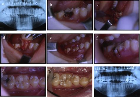 Autotransplantation Of Third Molars With Completely Formed Roots Into