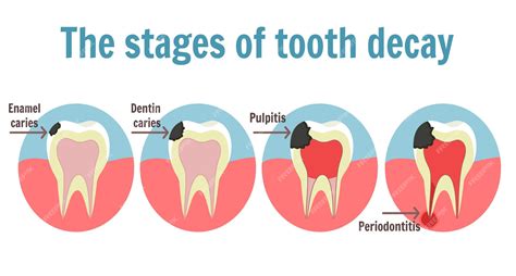 Infografía De Las Etapas De La Caries Dental Ilustración De Diente Con