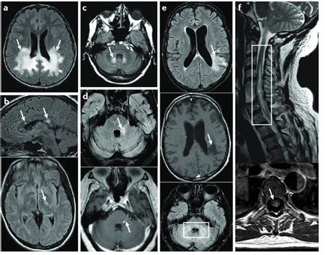 Imaging Features Of Other Multiple Sclerosis Mimics A Axial Download Scientific Diagram