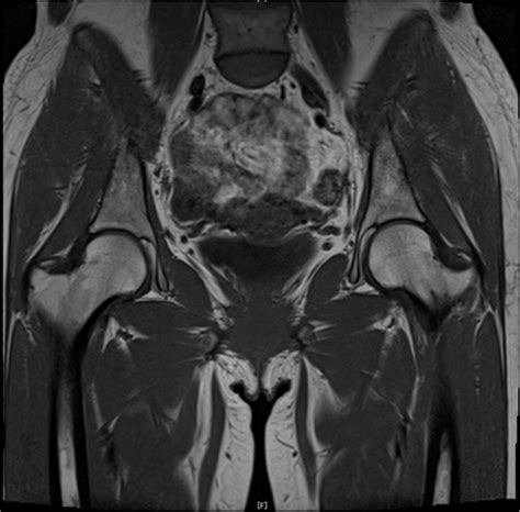 Magnetic Resonance Imaging Obtained After The Onset Of Bilateral Groin