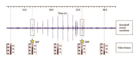Illustration Of Converted Korotkoff Sound Waveform With Some Examples