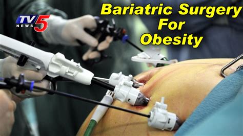 Bariatric Surgery For Severe Obesity Livlife Hospitals Health File