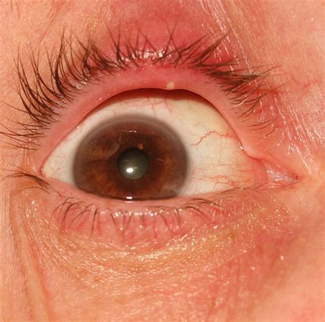 👉 Stye Pictures Contagious Symptoms Causes Treatment November 2021