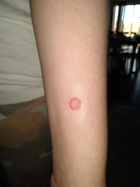 Does This Look Like Ringworm Babycenter
