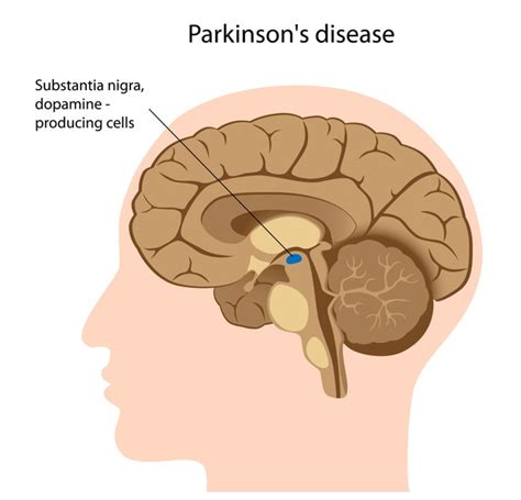 Parkinson Disease Medlineplus Genetics