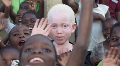 Shocking In Malawi Albinos Are Hunted And Killed To Bring Success