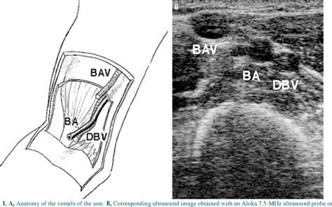 Brachial Vein Ultrasound