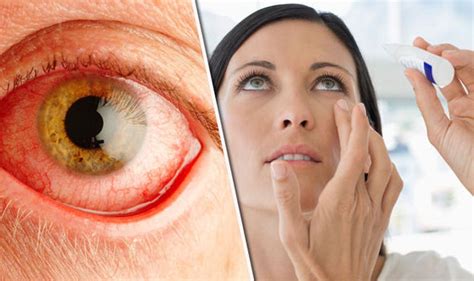 Red Eyes Symptoms Of Diabetes Diabeteswalls
