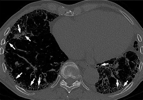 Diffuse Pulmonary Ossification In Fibrosing Interstitial Lung Diseases