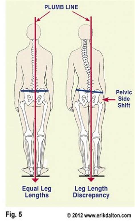 Plumb Line Leg Length Discrepency Scoliosis Exercises Scoliosis