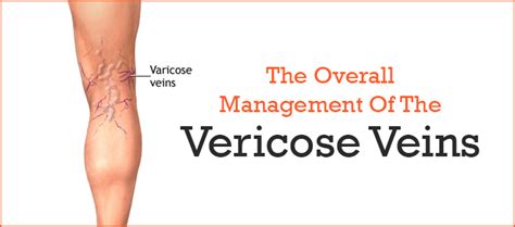 Karishma Vein Clinic Pune The Overall Management Of The Varicose Veins