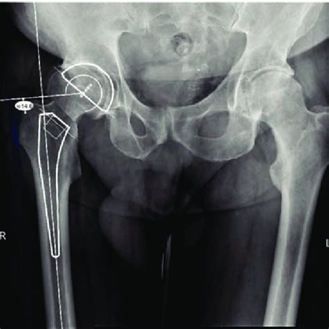 Radiological Outcome After Hip Replacement With Superpath Approach