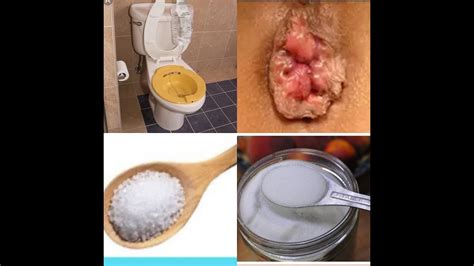 How To Treat Hemorrhoids At Home Naturally Within To Hours Relief YouTube