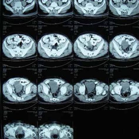 Abdomionopelvic Ct Scan With Oral And Intravenous Contrast Download