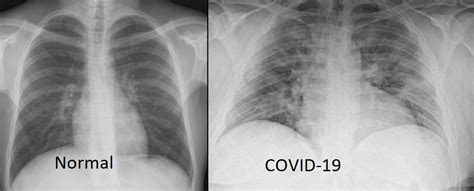 Copd Lungs Vs Normal Chest X Ray Sexiz Pix