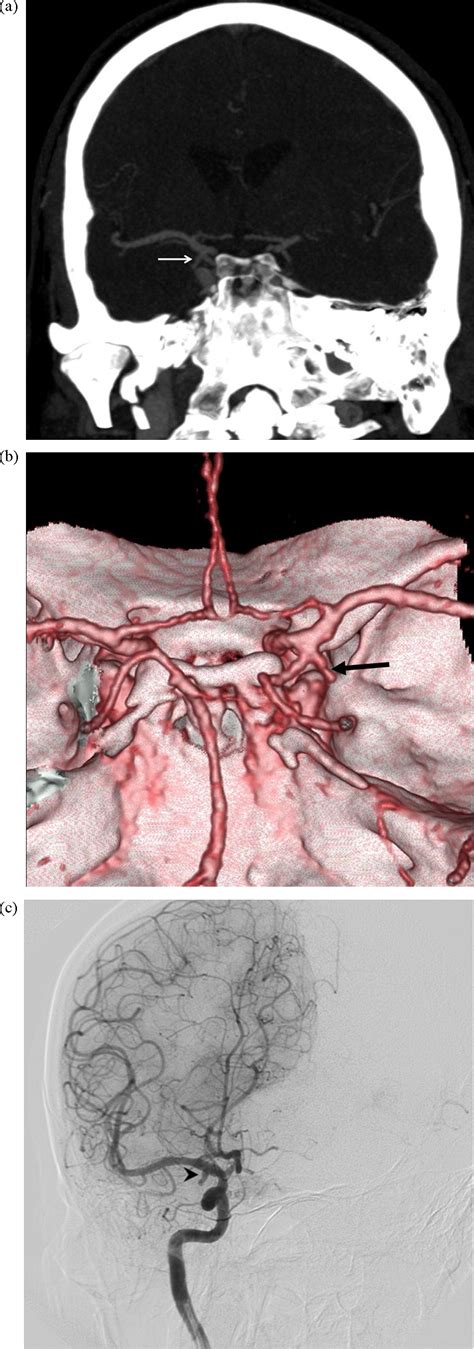 Comparison Of Row Multislice Ct Angiography With Conventional